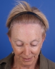 After Hair Transplant&nbsp;Hair Thinning